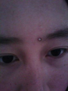 ：点痣手术的平安性与有效性概述