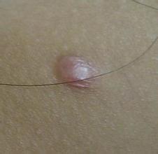 左肩痣相与晚婚的理性选择