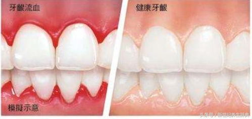 牙齿漏风对家居风水有何具体影响？