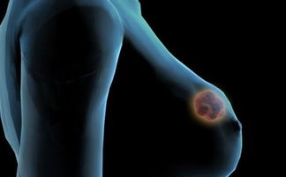 乳腺增生患者饮食禁忌之学术综述