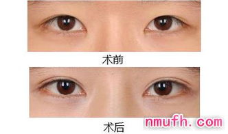 三、“双眼皮”整形项目技术细节及风险控制探讨