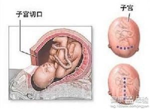 先兆子宫破裂的症状