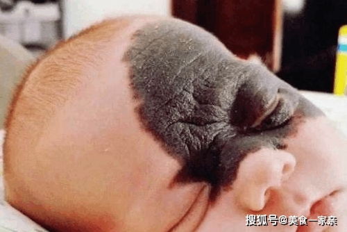 天生胎记的人命运会否忒别？