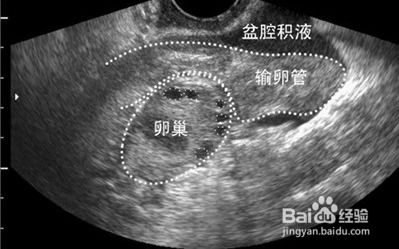 盆腔积液能否彻底治愈？