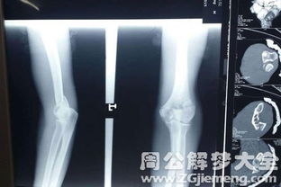 一、 孕妇与已婚女性群体夢見骨折之象徵意涵