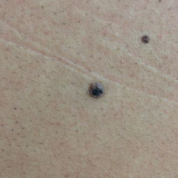 二、 不良痦子的干预策略：现代化技术手段与临床实践