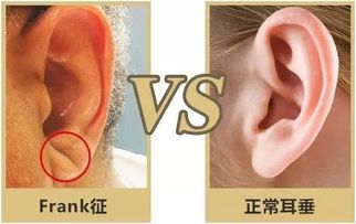 耳垂长度——古今共识之长寿标记