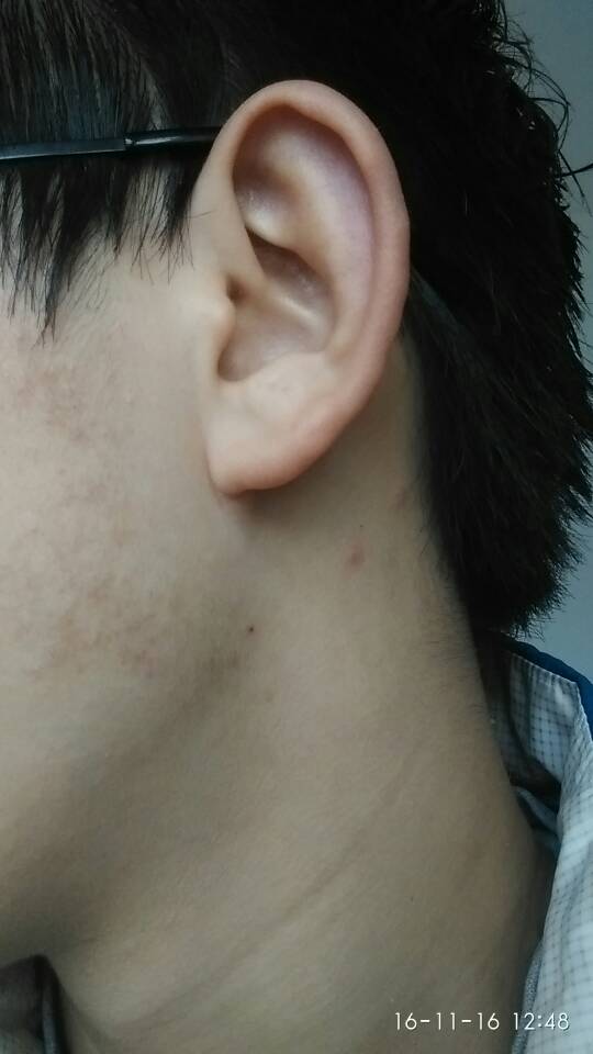 嘴角八字线到下巴的黑痕是什么原因造成的？