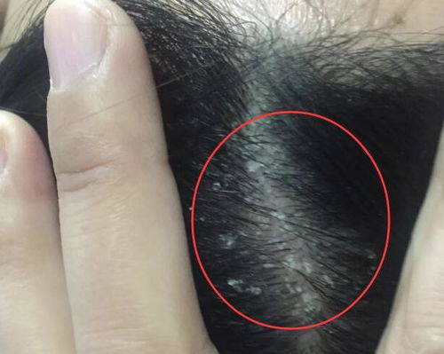 1. 防止螨虫蔓延的机制