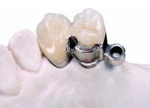 假牙象征哪个生肖？哪种活动假牙最为舒适和理想？