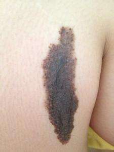 胎记长毛预示着怎样的命运，是好是坏呢？