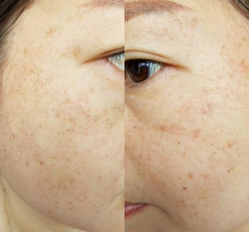 脸上雀斑如何用土办法有效淡化？