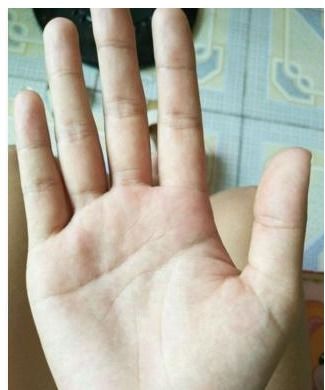 二、  手相断掌与异国情缘的必然性分析