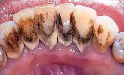 术后维护与口腔卫生管理的长效机制