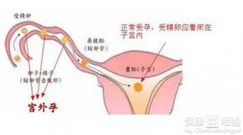 宫外孕， 存在风险因素的信号