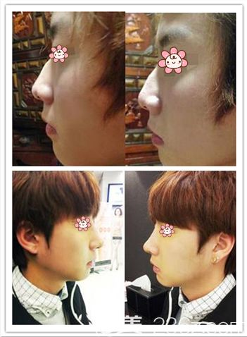 二、不同类型男性鼻相特征分析