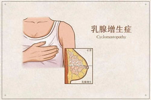 备孕期间乳腺增生：应对与提议