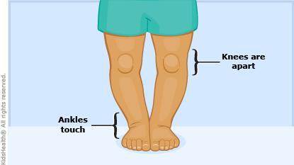 如何纠正孩子走路时一个腿外八字的问题？