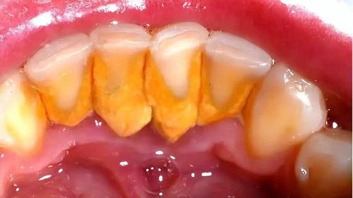 三、  喷砂洁牙技术的辅助作用