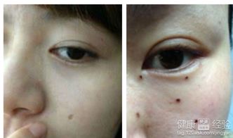 2. 激光点痣技术