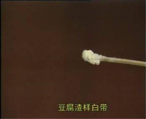 提前防范措施胜于医治：怎样避免白带异常？
