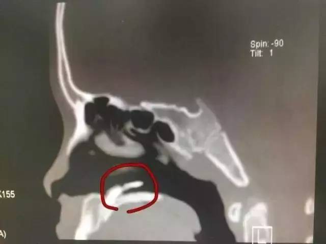 男人梦见掉后槽牙还出血是什么预兆？