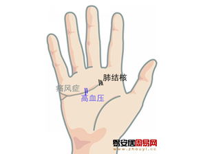 2. 末端被竖纹切断——肺结核可能性