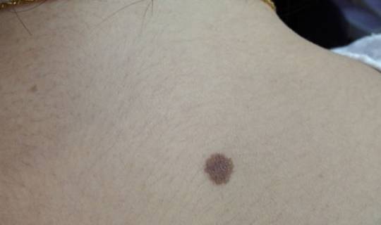 性别维度的语义解析：男性“面痣”与女性“面点”