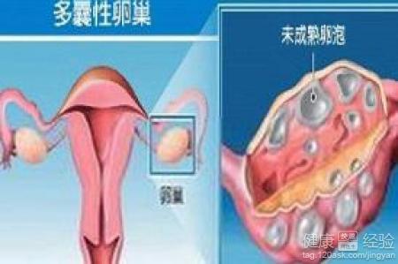 更进一步：更多囊卵巢综合征与排卵障碍