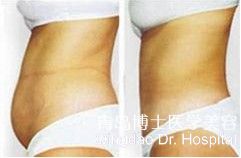 抽脂手术,真实的那么神奇吗?