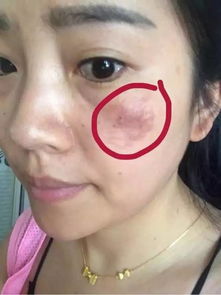 1. 交界痣的处理规范