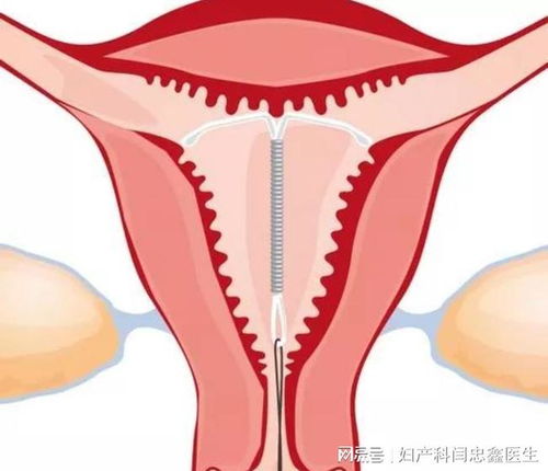 意外怀孕的风险因素