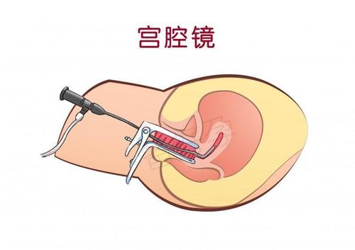 3. 宫腔镜+腹腔镜联合检查
