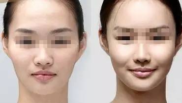 苹果肌太明显是哪种面相特征？如何改善饱满凸出的苹果肌面相？