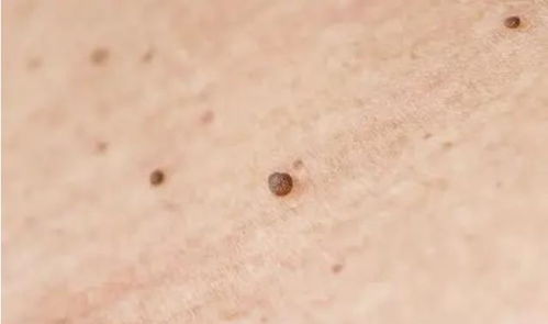 第一节：诱发痱子的外源性因素分析