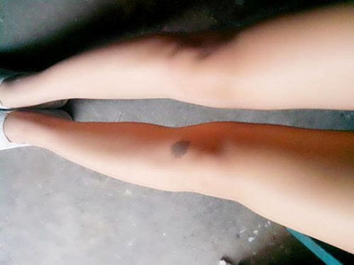 二、 现代医学视角下的胎记成因与生理特征