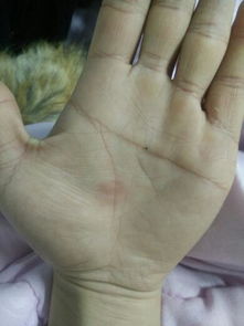 掌中八字男人左手心长痣是什么吉凶？