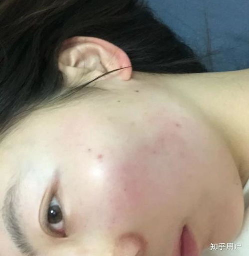 如何改善鼻子两侧八字纹、脸颊毛孔粗大和泛红问题？