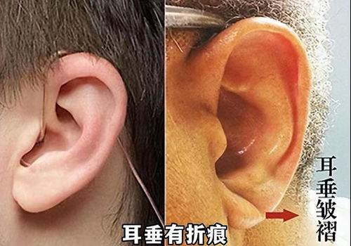 一、  厚耳肉与长寿：传统命理学的解读