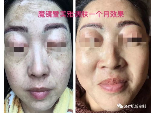 四、 遗传因素对眉间皮肤薄厚及胶原流失速度的影响