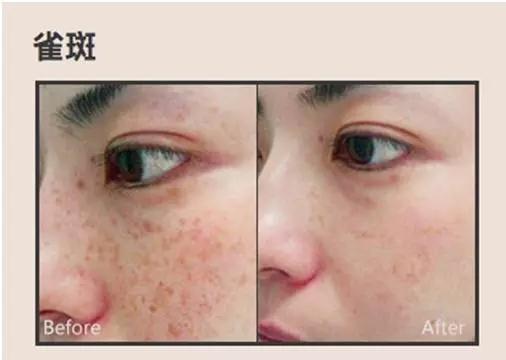 面部斑点的类型与成因：辨析基础
