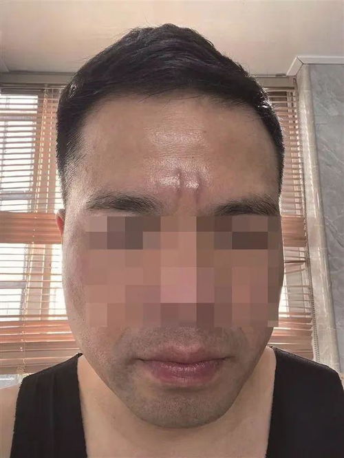 针对额头川字纹的不同解决方案