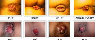 三、 肛肠疾病及其并发症