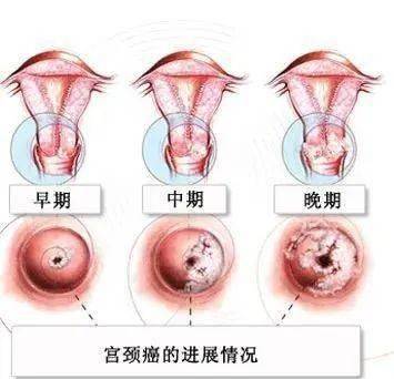 了解子宫颈癌