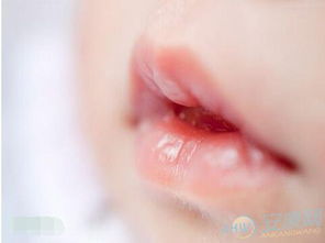 5. 嘴唇干裂及其背后的身心状态关联