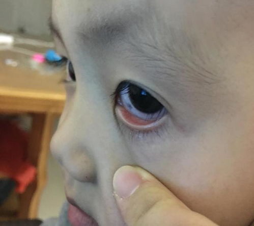 震惊！眼白上的黑点竟暗藏如此秘密