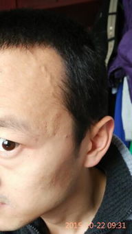 1. 额头青筋隆起的病理与心理意义