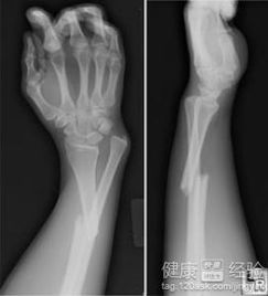 手臂骨折前会有哪些明显的不适症状？