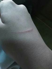 被兔子抓伤后轻微出血，这种情况需要怎么处理呢？