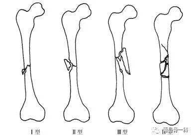 1. 头颅骨折及其并发症